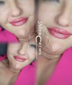 Gyógyult rúzsozott ajaktetoválás és ajakfeltöltés