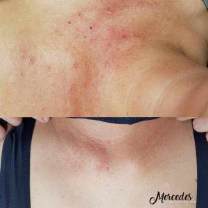 PhiLings ránctalanítás