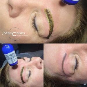 Sminktetoválás eltávolítás