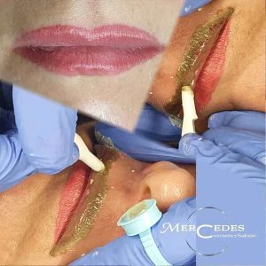 Sminktetoválás eltávolítás